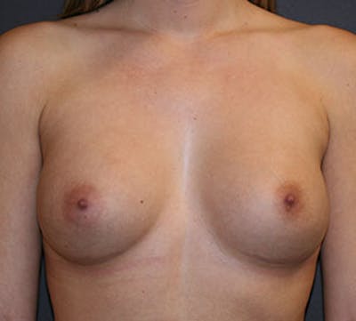 Breast Augmentation Before & After Gallery - Patient 106583054 - Image 2