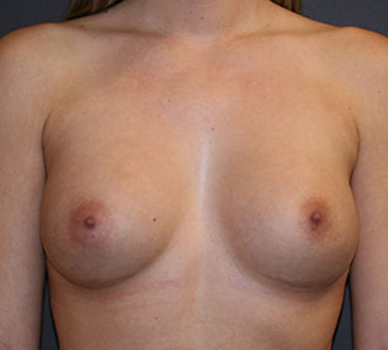 Breast Augmentation Before & After Gallery - Patient 106583054 - Image 2