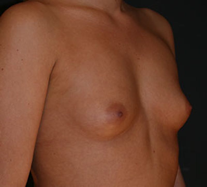 Breast Augmentation Before & After Gallery - Patient 106583054 - Image 3