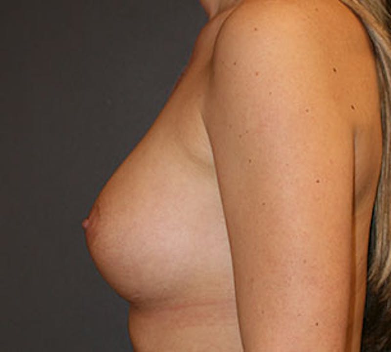 Breast Augmentation Before & After Gallery - Patient 106583054 - Image 10