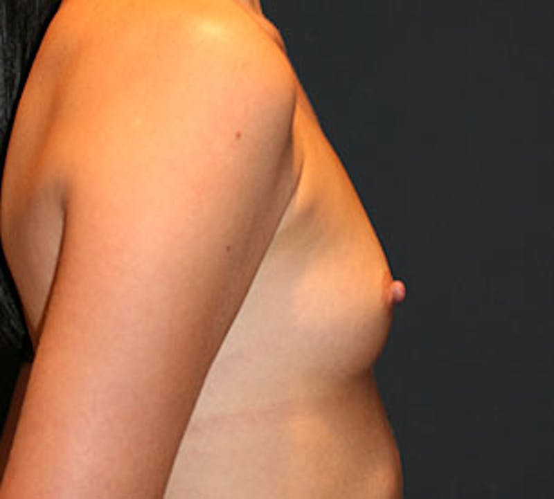 Breast Augmentation Before & After Gallery - Patient 106583056 - Image 7