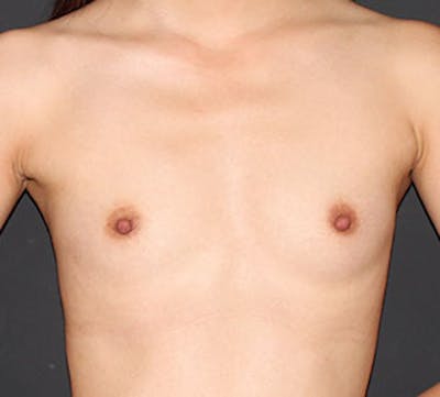 Breast Augmentation Before & After Gallery - Patient 106583081 - Image 1