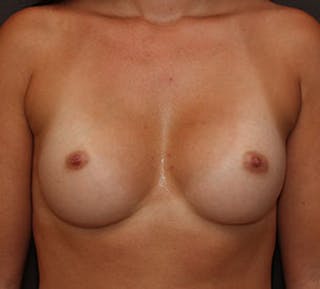 Breast Augmentation Before & After Gallery - Patient 106583082 - Image 2