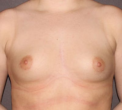 Breast Augmentation Before & After Gallery - Patient 106583083 - Image 1