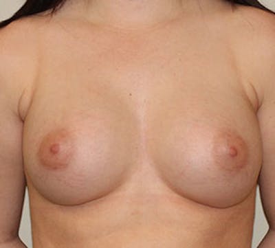 Breast Augmentation Before & After Gallery - Patient 106583083 - Image 2
