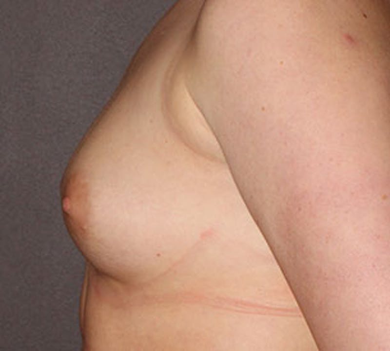 Breast Augmentation Before & After Gallery - Patient 106583083 - Image 9