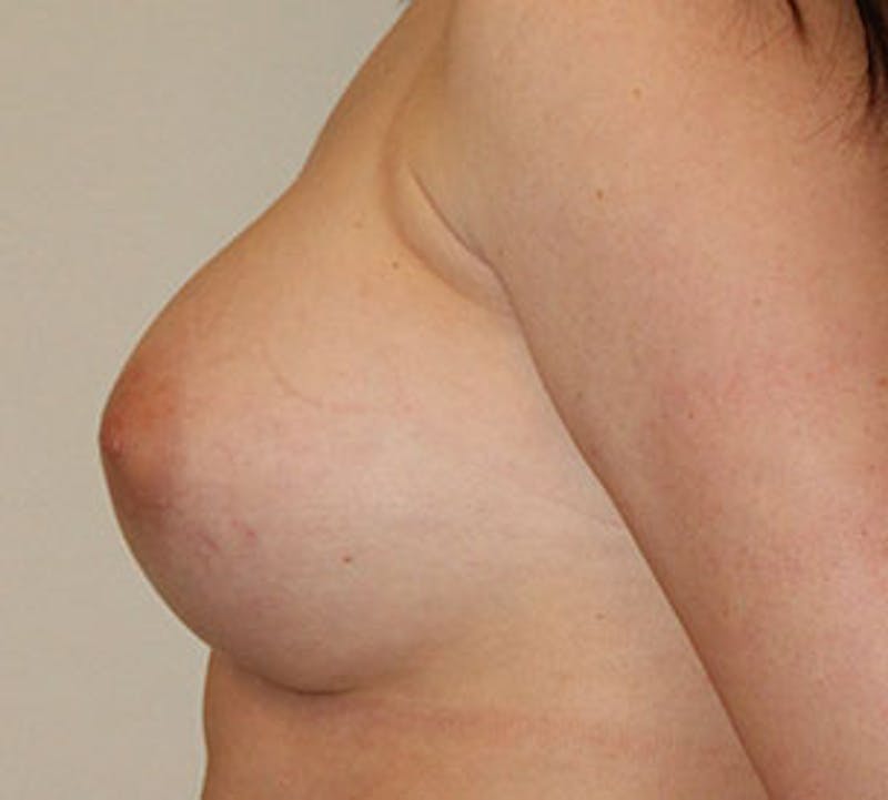 Breast Augmentation Before & After Gallery - Patient 106583083 - Image 10