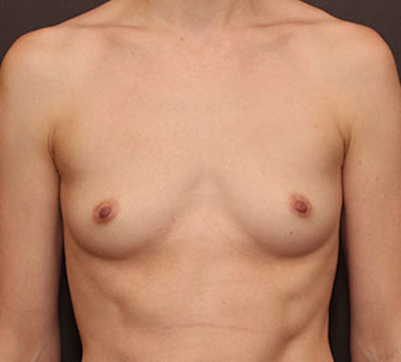 Breast Augmentation Before & After Gallery - Patient 106583086 - Image 1