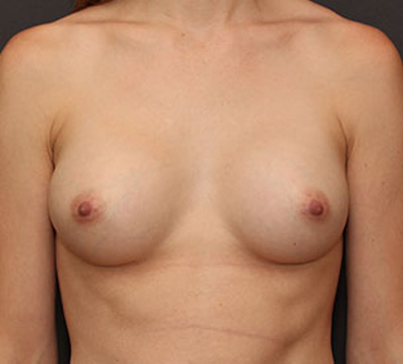 Breast Augmentation Before & After Gallery - Patient 106583086 - Image 2