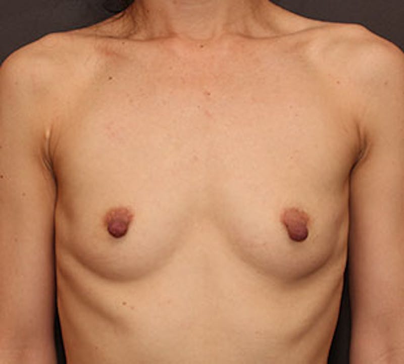 Breast Augmentation Before & After Gallery - Patient 106583088 - Image 1