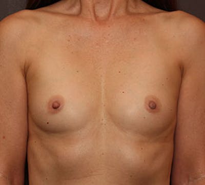 Breast Augmentation Before & After Gallery - Patient 106583090 - Image 1