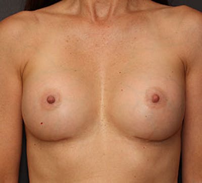 Breast Augmentation Before & After Gallery - Patient 106583090 - Image 2