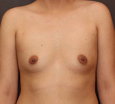 Breast Augmentation Before & After Gallery - Patient 106583097 - Image 1
