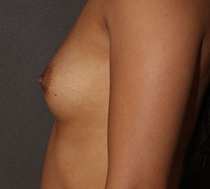 Breast Augmentation Gallery - Patient 106583108 - Image 9