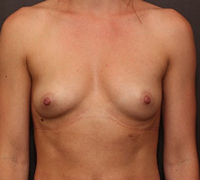 Breast Augmentation Before & After Gallery - Patient 106583141 - Image 1