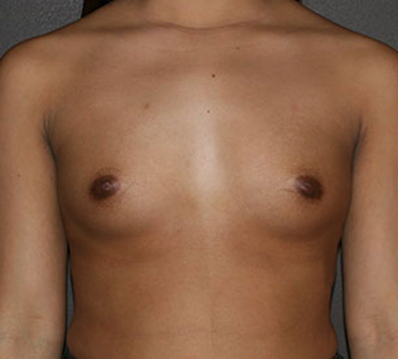 Breast Augmentation Gallery - Patient 106583162 - Image 1