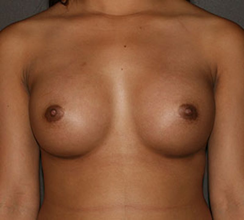 Breast Augmentation Before & After Gallery - Patient 106583162 - Image 2