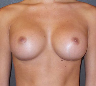 Breast Augmentation Before & After Gallery - Patient 106583166 - Image 2