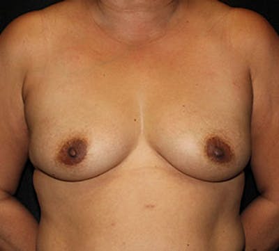 Breast Augmentation Before & After Gallery - Patient 106583171 - Image 1