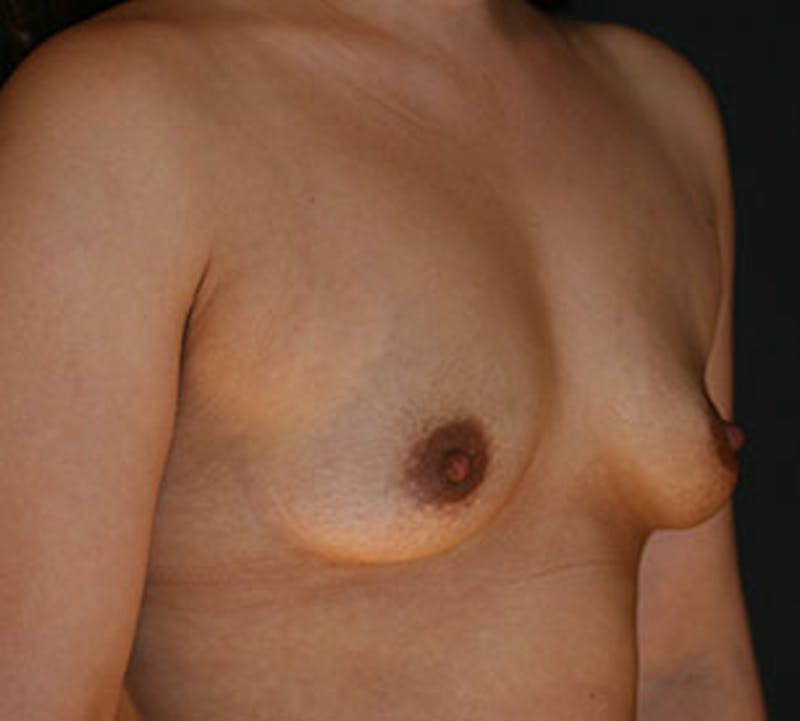 Breast Augmentation Gallery - Patient 106583180 - Image 3