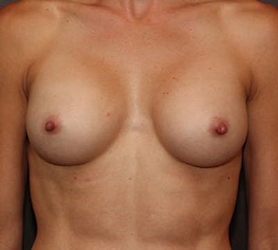 Breast Augmentation Before & After Gallery - Patient 106583185 - Image 2