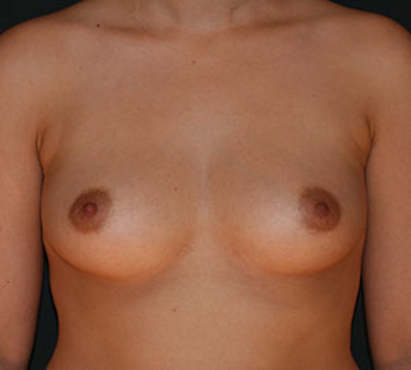 Breast Augmentation Before & After Gallery - Patient 106583257 - Image 1