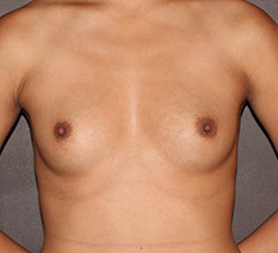 Breast Augmentation Before & After Gallery - Patient 106583487 - Image 1
