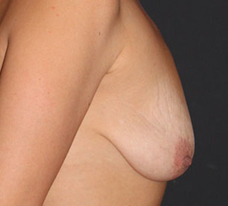 Augmentation-Mastopexy (Implant with Lift) Before & After Gallery - Patient 106584151 - Image 7