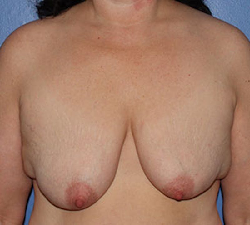 Augmentation-Mastopexy (Implant with Lift) Before & After Gallery - Patient 106584153 - Image 1