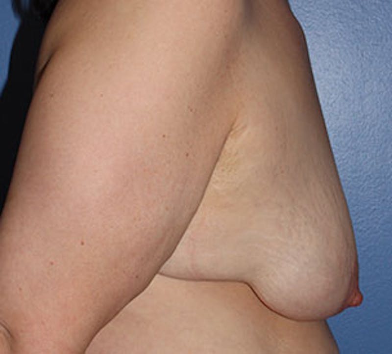 Augmentation-Mastopexy (Implant with Lift) Before & After Gallery - Patient 106584153 - Image 7