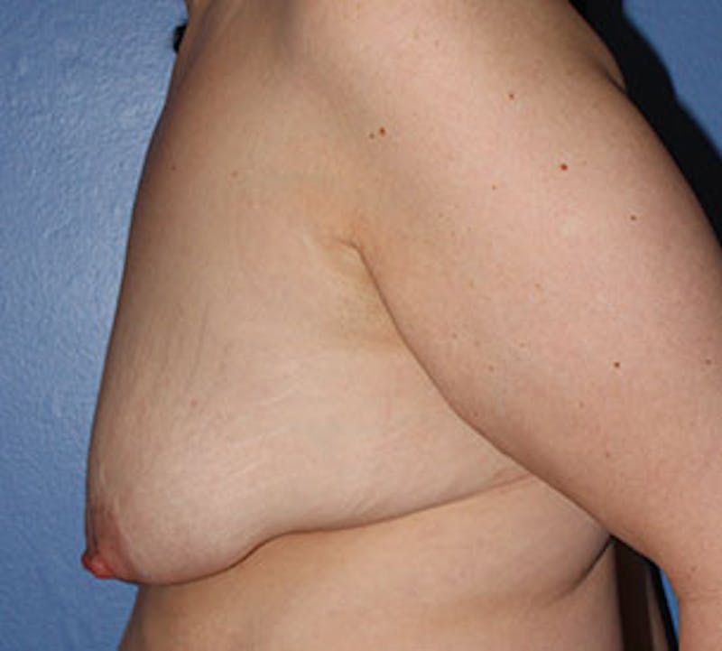 Augmentation-Mastopexy (Implant with Lift) Before & After Gallery - Patient 106584153 - Image 9