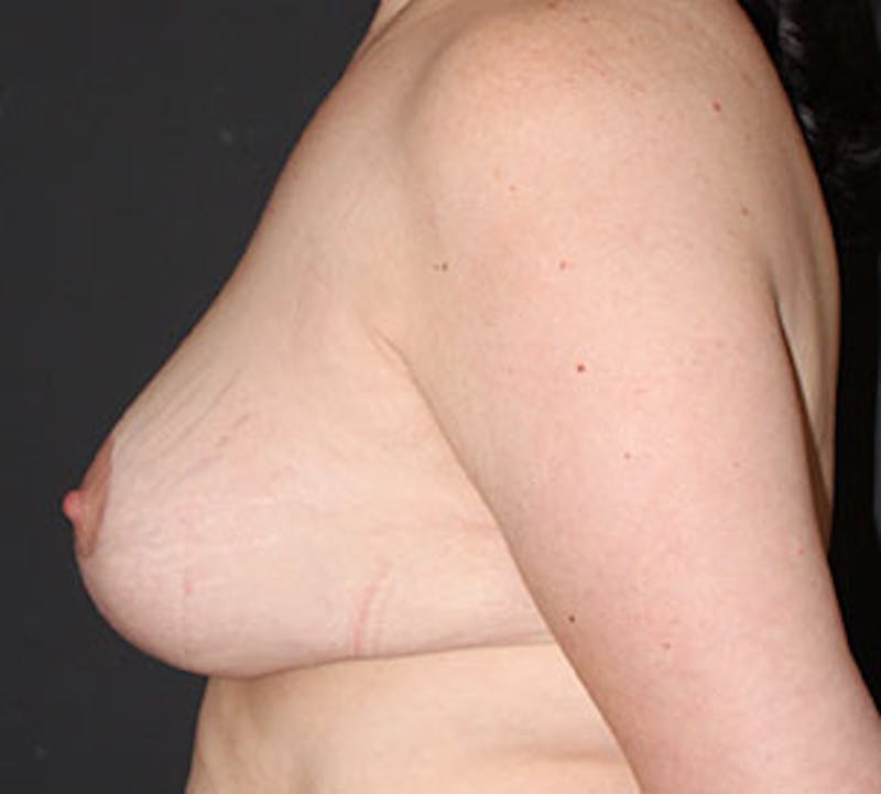 Augmentation-Mastopexy (Implant with Lift) Before & After Gallery - Patient 106584153 - Image 10