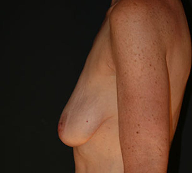 Augmentation-Mastopexy (Implant with Lift) Before & After Gallery - Patient 106584257 - Image 9