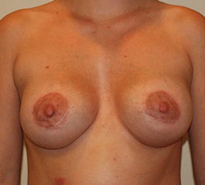 Augmentation-Mastopexy (Implant with Lift) Before & After Gallery - Patient 106584265 - Image 2