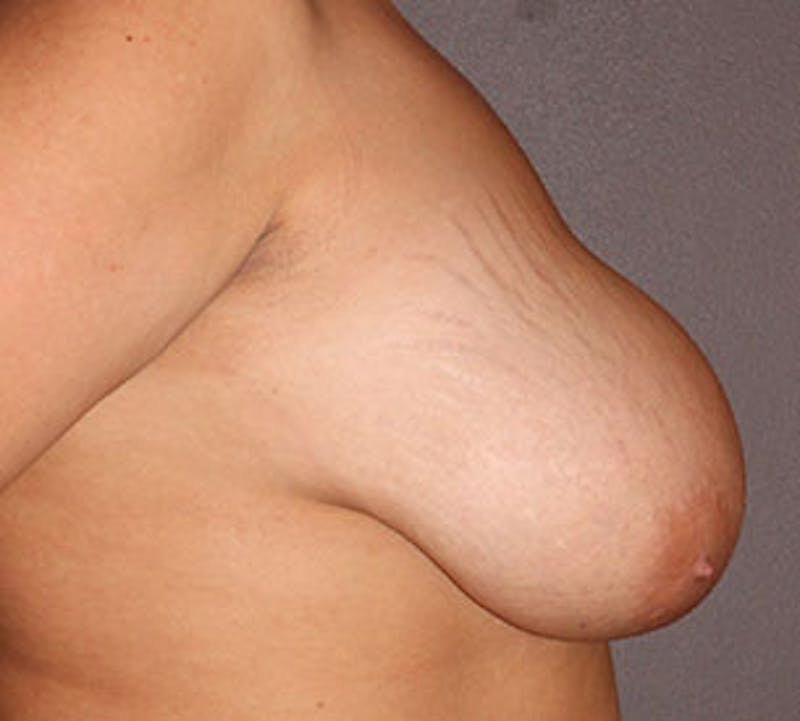 Breast Reduction and Mastopexy (Lift) Gallery - Patient 106603122 - Image 7