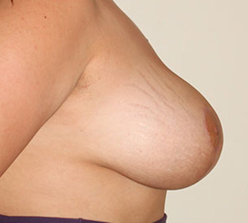 Breast Reduction and Mastopexy (Lift) Before & After Gallery - Patient 106603122 - Image 8