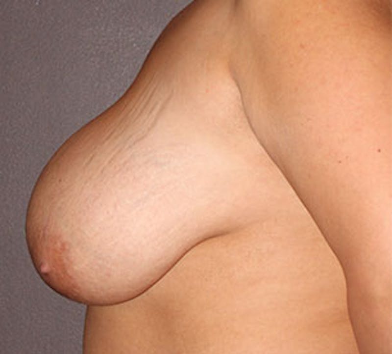 Breast Reduction and Mastopexy (Lift) Before & After Gallery - Patient 106603122 - Image 9
