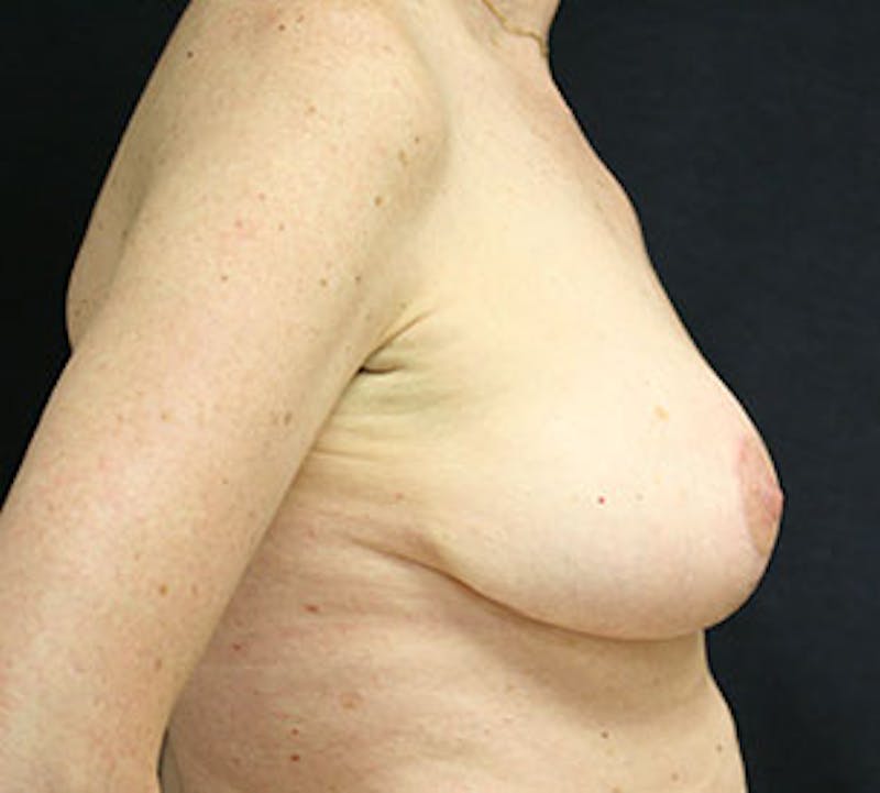 Breast Reduction and Mastopexy (Lift) Before & After Gallery - Patient 106603143 - Image 8