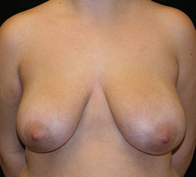 Breast Reduction and Mastopexy (Lift) Before & After Gallery - Patient 106603144 - Image 1