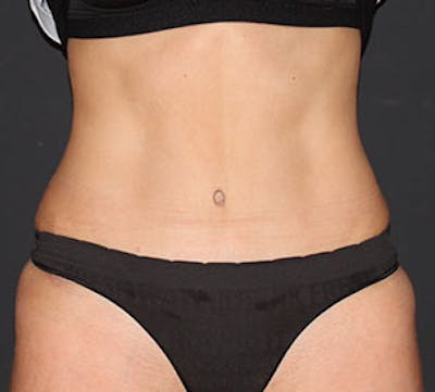 Abdominoplasty (Tummy Tuck) Before & After Gallery - Patient 106984723 - Image 2