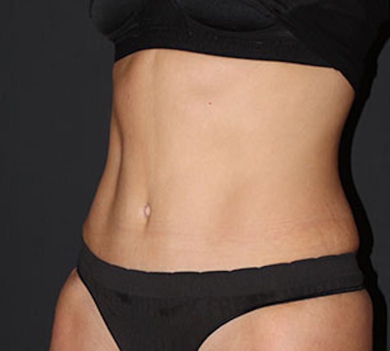 Abdominoplasty (Tummy Tuck) Before & After Gallery - Patient 106984723 - Image 6