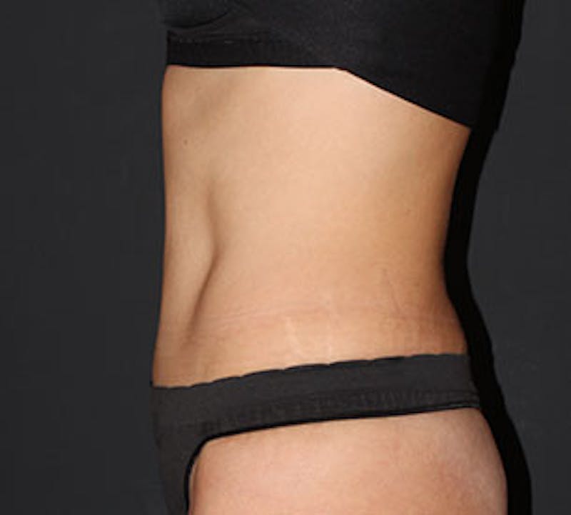 Abdominoplasty (Tummy Tuck) Before & After Gallery - Patient 106984723 - Image 10