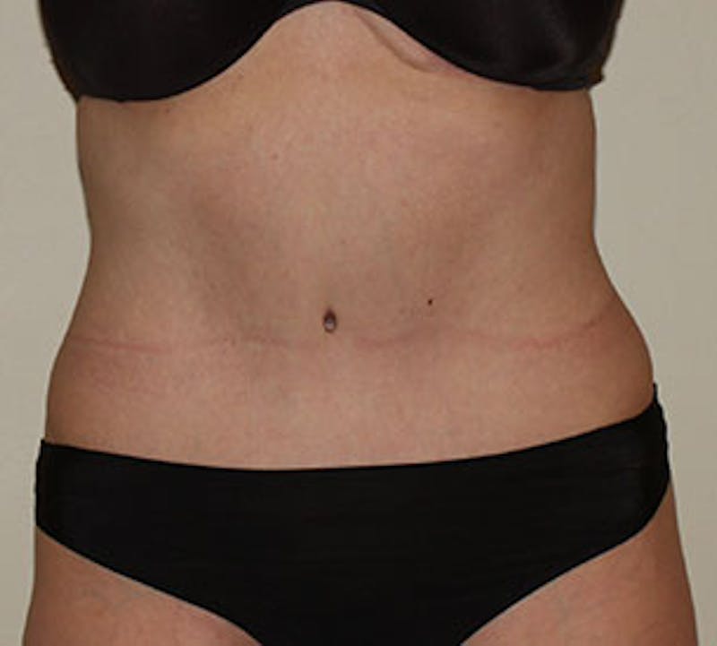 Abdominoplasty (Tummy Tuck) Before & After Gallery - Patient 106984735 - Image 2