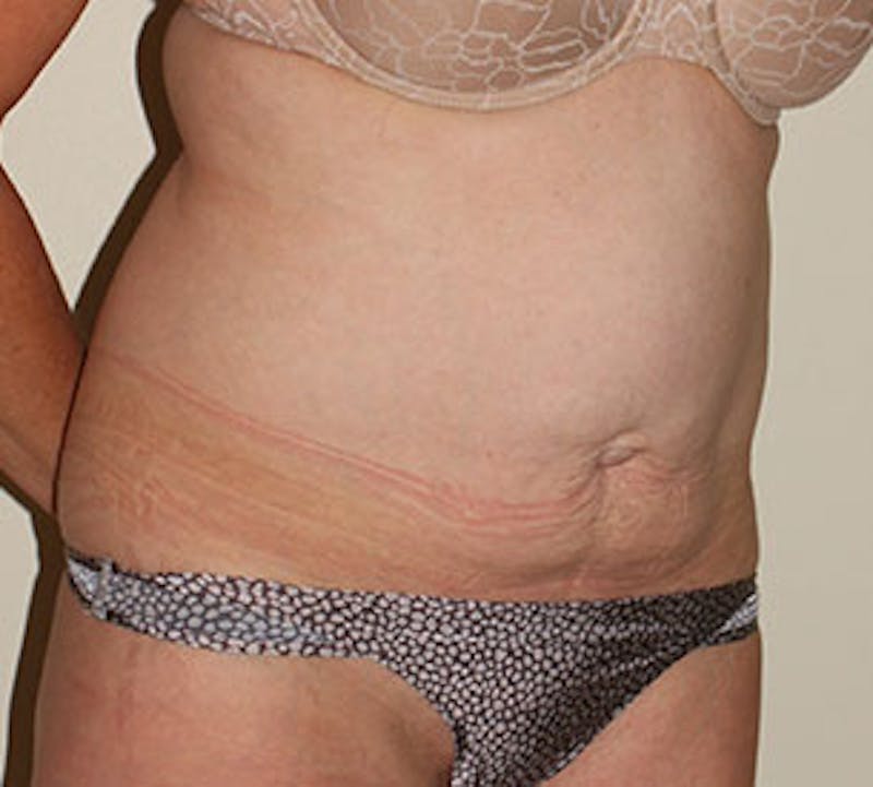 Abdominoplasty (Tummy Tuck) Before & After Gallery - Patient 106984735 - Image 3