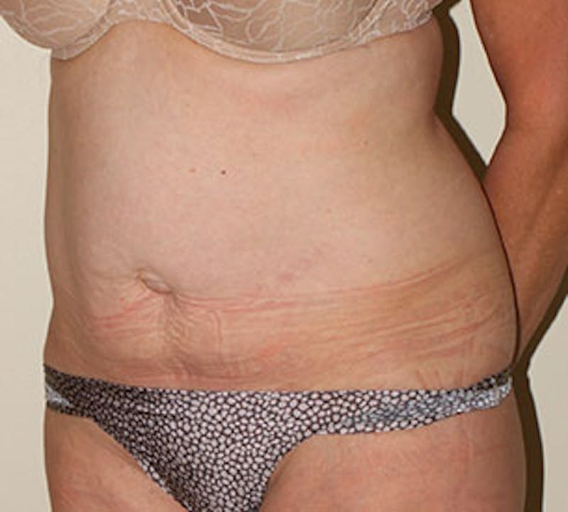 Abdominoplasty (Tummy Tuck) Before & After Gallery - Patient 106984735 - Image 5