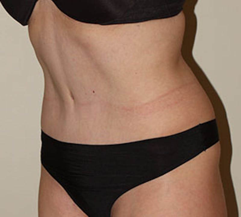 Abdominoplasty (Tummy Tuck) Before & After Gallery - Patient 106984735 - Image 6