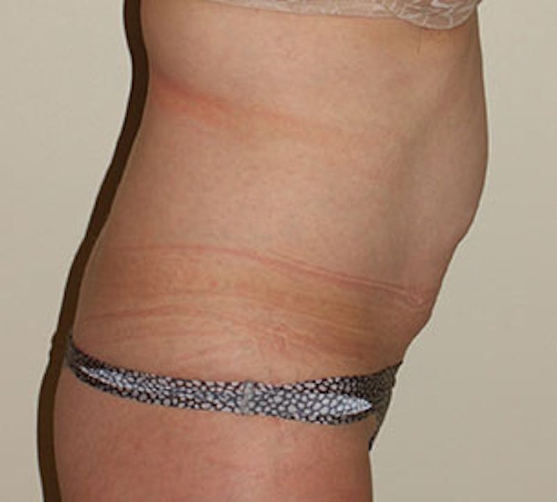 Abdominoplasty (Tummy Tuck) Before & After Gallery - Patient 106984735 - Image 7