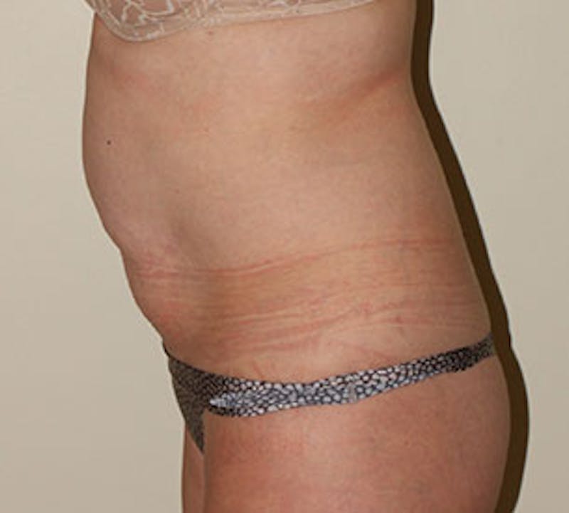 Abdominoplasty (Tummy Tuck) Before & After Gallery - Patient 106984735 - Image 9