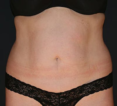 Abdominoplasty (Tummy Tuck) Before & After Gallery - Patient 106984745 - Image 1