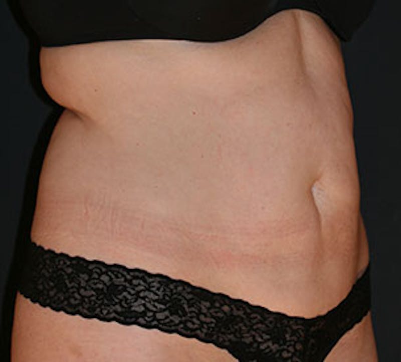 Abdominoplasty (Tummy Tuck) Before & After Gallery - Patient 106984745 - Image 3